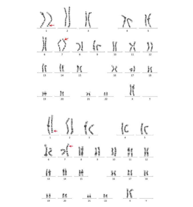 Karyotype of the mother, showing balanced translocation between chromosomes 1 and 7.