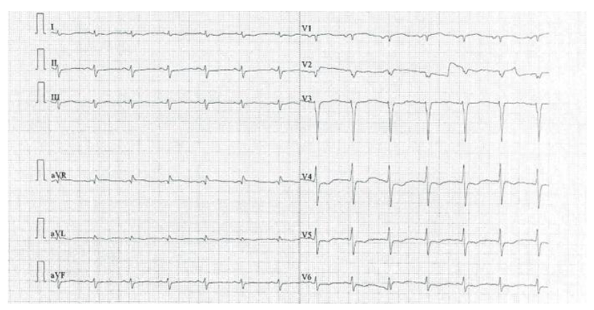 Figure 1: Poor R-wave progression in V1–V4 chest leads with left ventricular hypertrophy on 12-lead electrocardiogram.