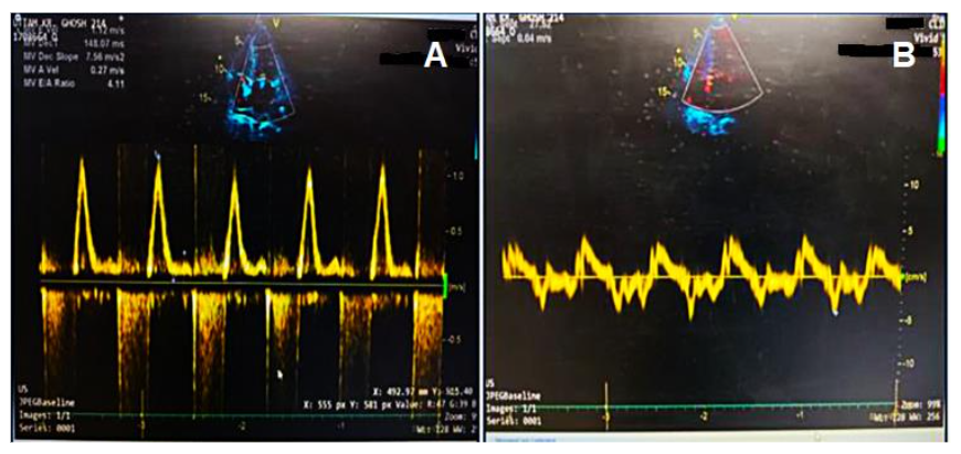 Figure 2: (a) Marked increase in early diastolic mitral inflow velocity with reduced late diastolic peak flow velocity and deceleration. (b) Decreased early diastolic mitral annulus velocity is shown.