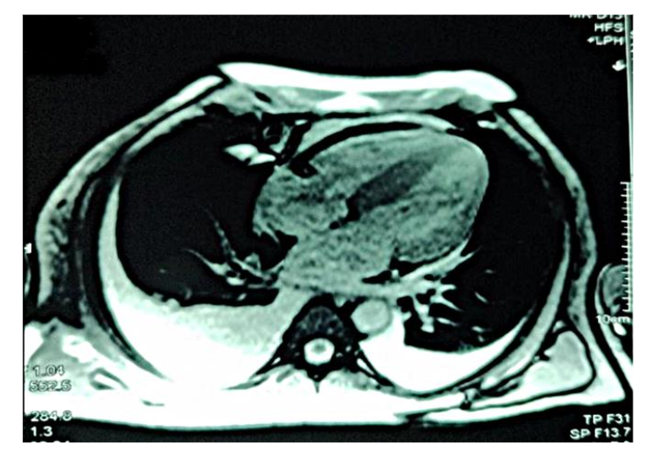 Figure 3: Diffuse global late gadolinium enhancement observed on cardiac magnetic resonance imaging.