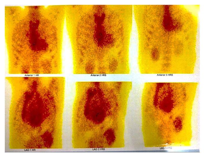Figure 4: Absence of abnormal myocardial uptake in Tc-99m pyrophosphate scan.