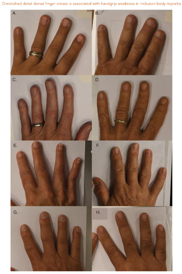 Figure 1. Examples of loss of finger creases in patients with IBM: Subjects A, C, E, and G identified as IBM and have reduction in dorsal distal interphalangeal creases. B, D, F, and H are sex- and age-matched controls with normal finger creases.