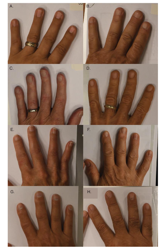 Figure 1. Examples of loss of finger creases in patients with IBM: Subjects A, C, E, and G identified as IBM and have reduction in dorsal distal interphalangeal creases, B, D, F, and H are sex- and age-matched controls with normal finger creases.