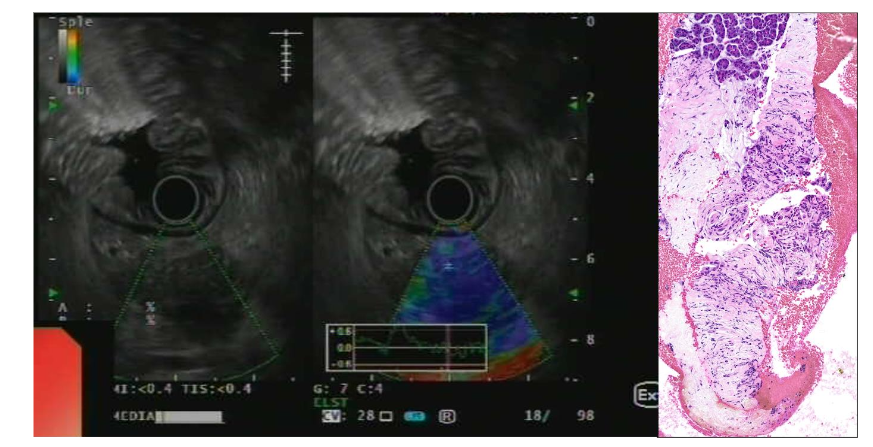 EUS imaging showing a pancreatic neuroendocrine tumor with a low stroma ratio. Biopsy reveals monomorphic neoplastic cells with minimal atypia in trabecular pattern. The stroma is minimal, rich in vascular with fine, capillary-sized vessels (H&E, 200x). Neoplastic cells express chromogranin A and synaptophysin with a slightly elevated Ki67 proliferation index (Ki67 immunostaining, 200x).