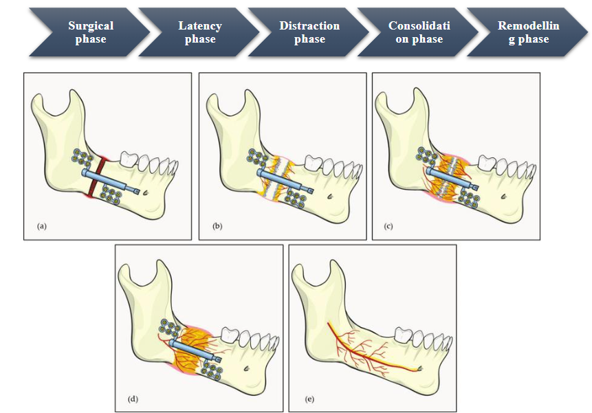 Figure 1- The phases of distraction osteogenesis. (a) Latency phase which is preceded by surgical phase and in which hematoma formation occurs. (b) Distraction phase in which the bone gap is increased at margins by osteogenesis. (c) Consolidation phase, centre of bone gap experiences osteogenesis. (d) Late consolidation phase, ossified matrix matures in the chamber of distraction. (e) Remodelling phase, continuity of bone and alveolar canal established.