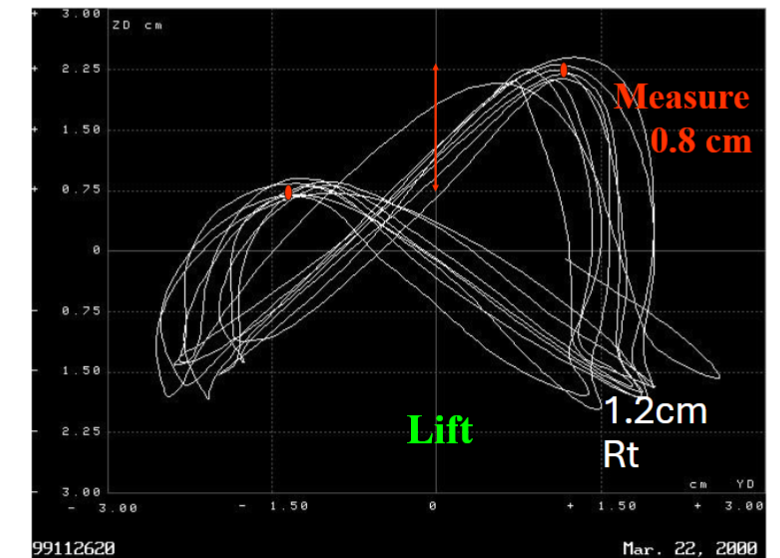 Fig 6: Right sided lift of 1.2 cm and the patient self-adjusts so it measures 8 mm.