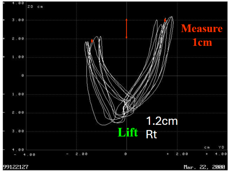 Fig 2: 1.2 mm lift on the right side. Some adjustment by the patient only measure 1 cm of difference.