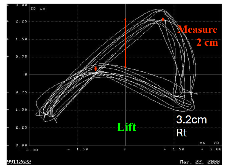 Fig 8: A 3.2 cm lift on the right side looking front to back. The patient self-adjusts so the difference is 2.75 cm.
