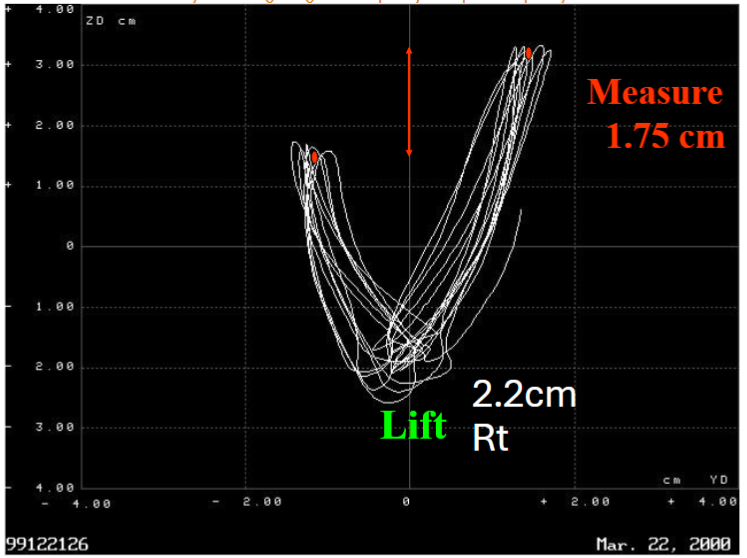 Fig 3: 2.2 cm lift. Patient adjusts so only measures 1.75 cm of difference.