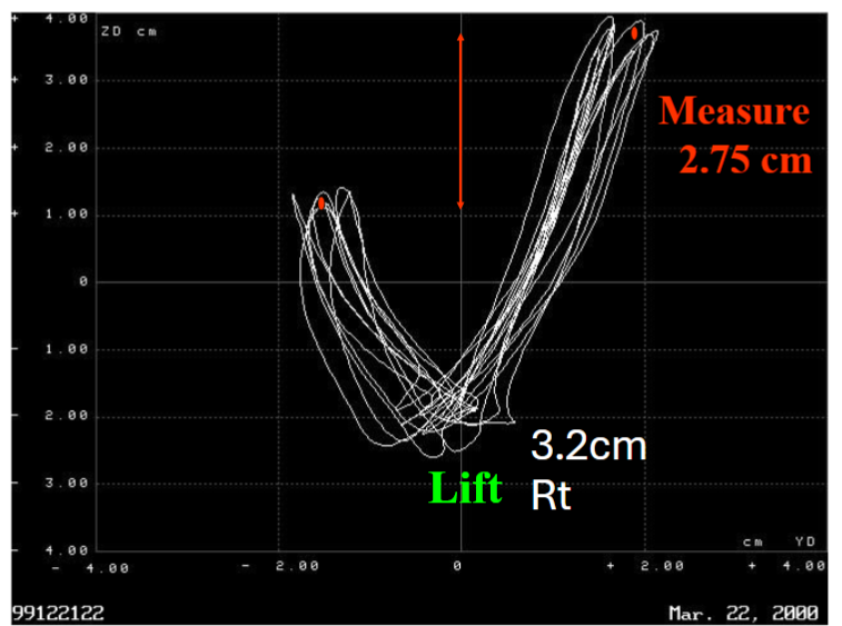 Fig 4: A 3.2 mm lift. The patient self-adjusts for the lift so it measures 2.75 cm of difference.