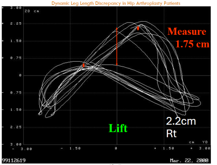 Fig 7: The patient has a 2.2 cm lift on the right side. The patient self-adjusts to have a 1.75 cm difference.