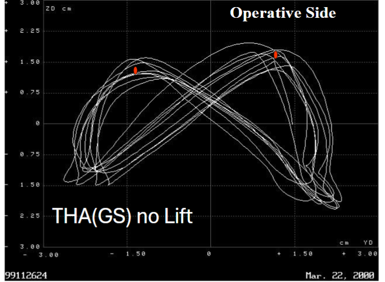 Fig 5: Looking at the patient front to back. The patient had a THR on the right side and has a slight leg lengthening.