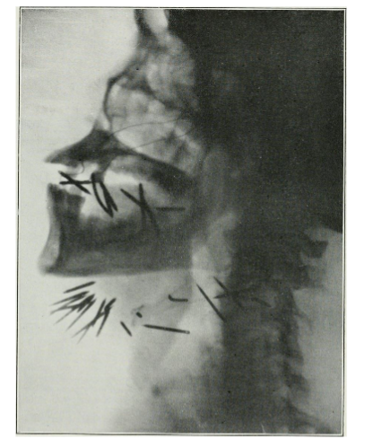 Figure 1: X-ray of the lower cranium and neck of a patient undergoing radium treatment of the tongue and glands with "radium needles" from around 1921/22. The needles were inserted directly into the tissue to treat carcinoma of the tongue. Medical Archives, Volume 1, July 1922. Volume 1 (New Series), No. 2. 113-124. P. 115, figure 2.