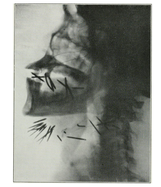Figure 1: X-ray of the lower cranium and neck of a patient undergoing radium treatment of the tongue and glands with "radium needles". From the archives from around 1921/22. The needles were inserted directly into the tumor to treat carcinoma of the tongue. The picture is taken from Boggs, Russell N. "The Treatment of Epithelioma by Radium". Radium. July 1922. Volume 1 (New Series), No. 123-124. P. 115, figure 2.