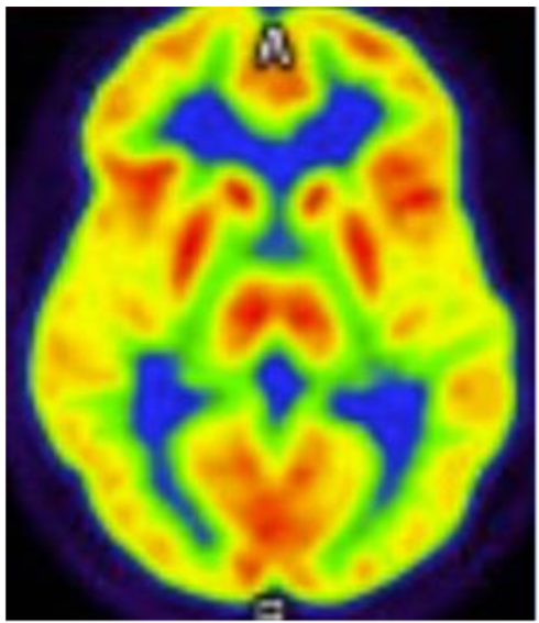 Early-Onset Dementia with Lewy Bodies and PRKN Mutation - European ...