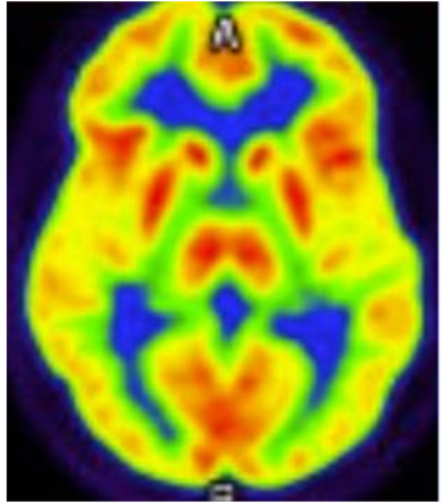Figure 2 shows a PET-FDG MR Brain axial cross-section performed 14 months later, which re-demonstrates bilateral parietal and occipital hypometabolism, with preserved cingulate island sign, further supporting a diagnosis of dementia with Lewy bodies.