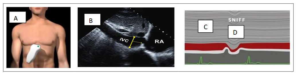 Figure 2. RAP estimation based on inferior vena cava diameter in the subcostal view (A-B) during inspiration (C) and expiration (D) maneuver (D).
