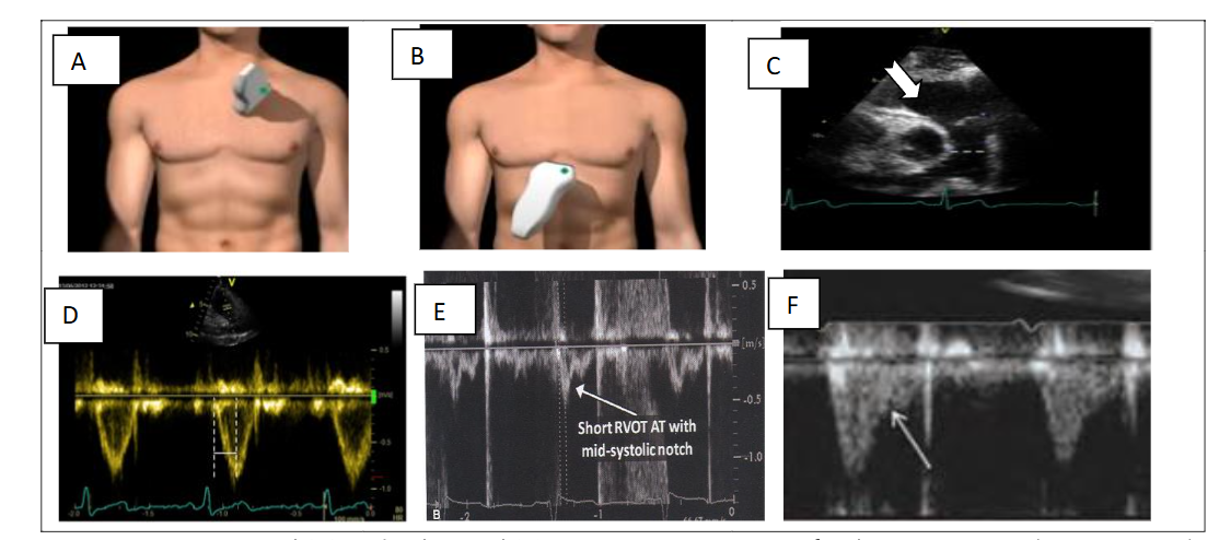 Figure 3. Subcostal (A) and apical (B) views. Decreased tricuspid annular plane systolic excursion (TAPSE) (C-D) and right ventricular area change (E).