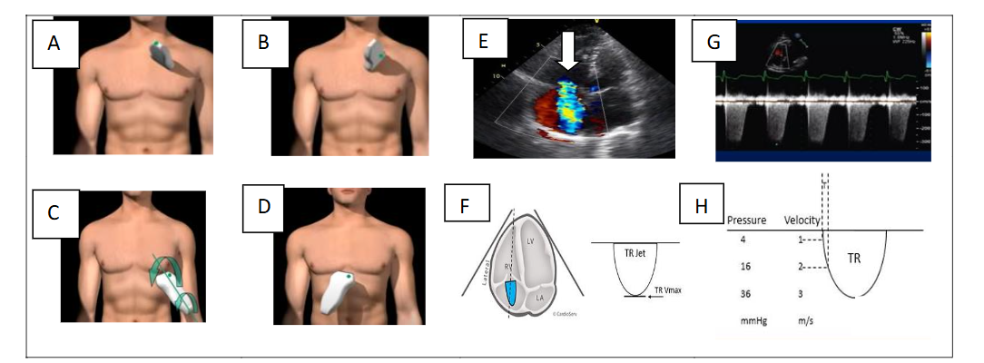 Figure 1. Estimation of sPAP with Tricuspid Regurgitation Velocity (TRV): parasternal short-axis (A) and apical (B, C, D) views; TRV profile (A) using Doppler (E-F-G-H).
