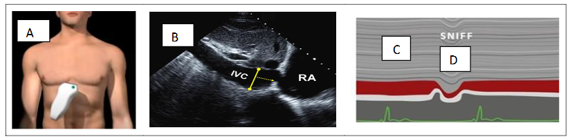 Figure 2. RAP estimation based on inferior vena cava diameter in the subcostal view (A-B) during inspiration (C) and after sniff maneuver (D).