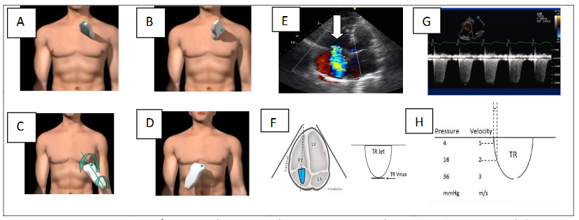 Figure 1. Estimation of sPAP with Tricuspid Regurgitation Velocity (TRV): parasternal short-axis (A), apical (B), subcostal (D) views; RAP profile (C) using Doppler (E-F-G-H).