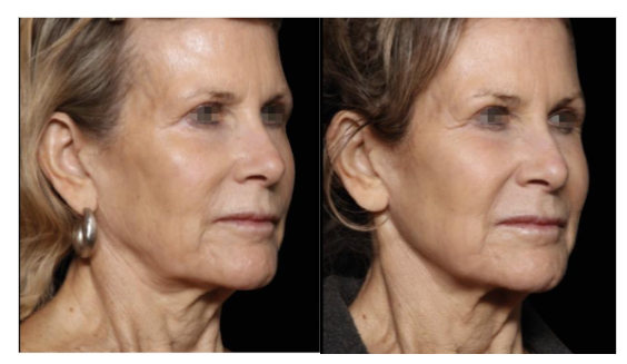 Figure 5. Photographs of a 71-year-old female taken at baseline (left) and at the 3-month follow-up visit (right) demonstrate significant improvements in the neck and cheek areas, resulting in a more youthful appearance.