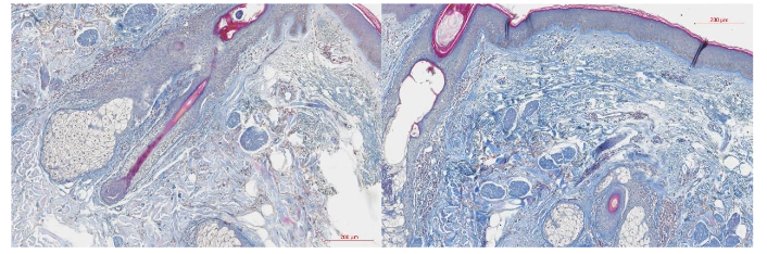 Figure 1. Histological comparison of collagen levels at baseline (left) and 3-month follow-up (right). The increase in collagen is indicated by an intensification of the blue color.