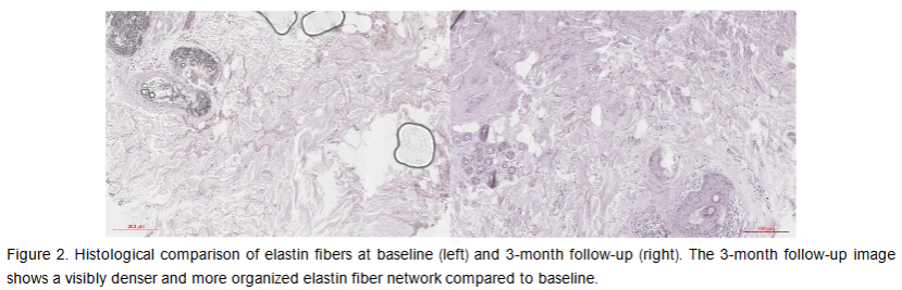 Figure 2. Histological comparison of elastin fibers at baseline (left) and 3-month follow-up (right). The 3-month follow-up image shows a visibly denser and more organized elastin fiber network compared to baseline.