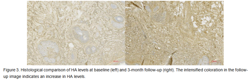 Figure 3. Histological comparison of HA levels at baseline (left) and 3-month follow-up (right). The intensified coloration in the follow-up image indicates an increase in HA levels.