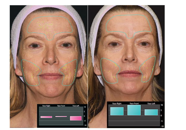Figure 6. Photographs of a 67-year-old woman taken at baseline (left) and at the 3-month follow-up visit (right) demonstrate noticeable improvements in skin color evenness, wrinkle reduction, and overall facial rejuvenation.