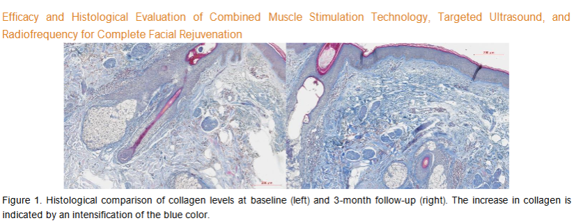Figure 1. Histological comparison of collagen levels at baseline (left) and 3-month follow-up (right). The increase in collagen is indicated by an intensification of the blue color.