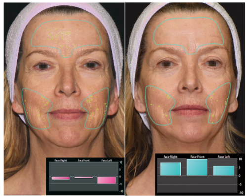Figure 5. Skin analysis software provided numerical assessments of pore size in a 60-year-old woman, based on photographs taken at baseline (left) and at the 3-month follow-up (right). The bar graphs measured pore size in specific facial regions, with reduced bar height at follow-up indicating overall improvement.