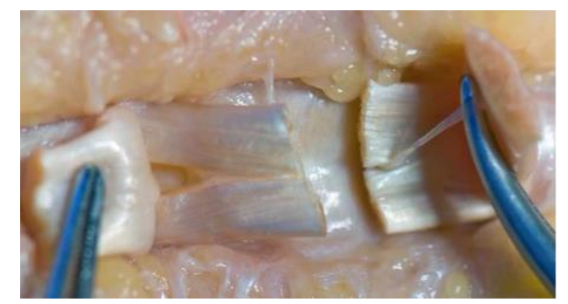 Figure 1: Anatomy of Zone II flexor tendon injury showing the relationship of the FDP and FDS