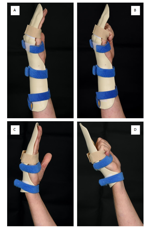 Figure 3: The two splint designs