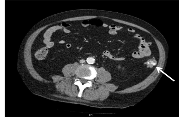 Figure 1: Localisation of an acute left intra-colonic bleed by CT angiography.