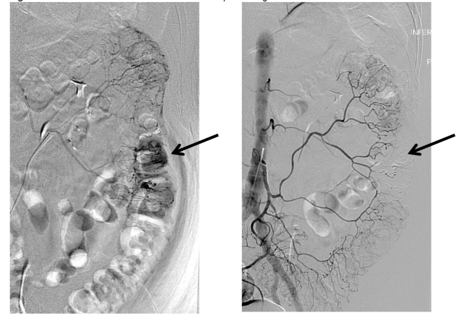 Figure 2: Identification and embolization of actively bleeding lower GI blood vessels.