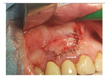 Suturation 6-0 nylon, reverse cutting needle, length 12 mm