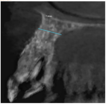 CBCT after 6 months post-op showed excellent regeneration of both cortical plates in range almost 8.0 mm!