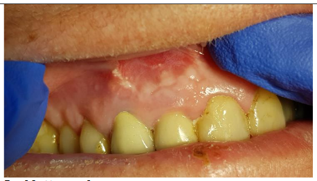 Mucosa 2 years post-op
