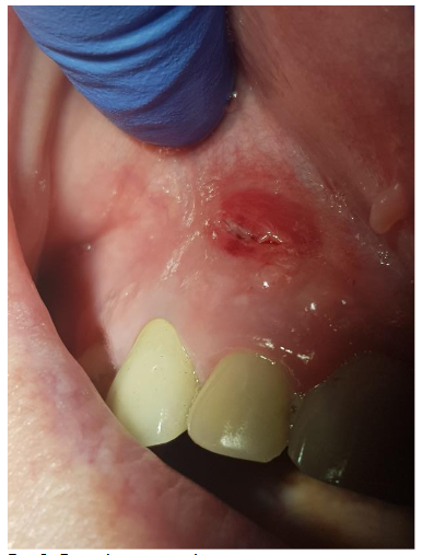 Four days post abscess incision