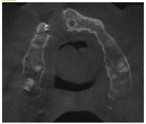 CBCT horizontal. Visible damage of buccal and palatal plate