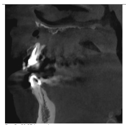 CBCT lateral scan