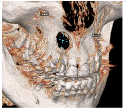 3D scan confirmed that cyst in the right maxilla totally damaged both laminas