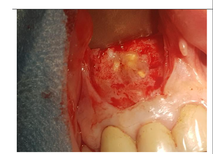 After flap opening the structure of the cyst is visible