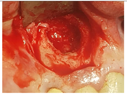After cyst removal and apicoectomy of tooth 12