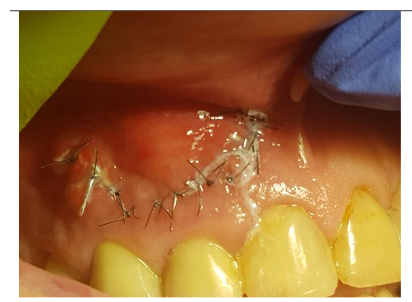 Mucosa 7 days post-op
