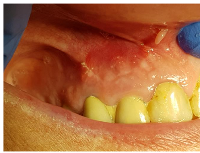Mucosa 3 months post-op