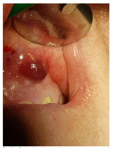 First clinical symptom was a vestibular abscess