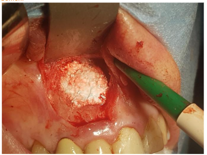 Bond Apatite inside the bone defect(2cc)