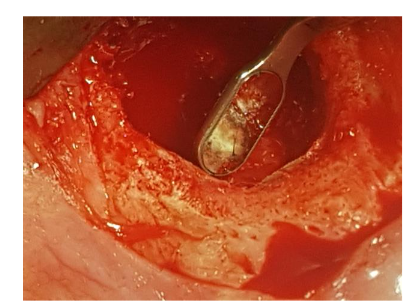 Backfill of the root 12 canal with MTA